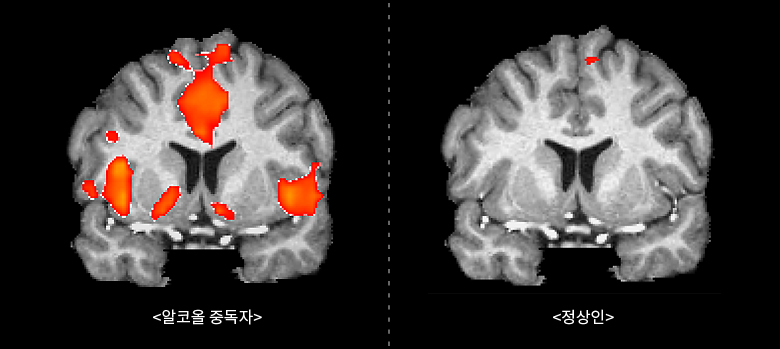 알코올 중독자와 일반인의 뇌의 비교 - 술 사진을 보여주고 찍었을 때 일반인의 뇌는 별다른 변화가 없지만 알코올 중독자의 뇌는 술을 마시고 싶게 만드는 부위가 빨갛다.  