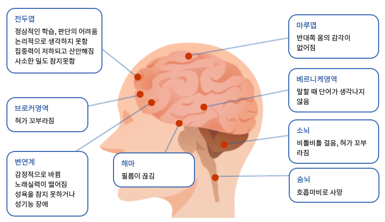 술이 뇌에 미치는 영향 - [전두엽 : 정상적인 학습, 판단의 어려움 논리적으로 생각하지 못함,사소한 일도 참지못함 ]  , [ 마루엽 : 반대쪽 몸의 감각이 없어짐 ]  , [ 브로커영역 : 혀가 꼬부라짐 ] , [변연계  : 감정적으로 바뀜 노래실력이 떨어짐, 성기능 장애] ,[베르니케영역 : 말할 때 단어가 생각나지  않음 ] , [ 소뇌  : 비틀비틀 걸음, 혀가 꼬부라짐 ] , [ 숨뇌 : 호흡마비로 사망 ] ,  [ 해마 : 필름이 끊김 ] 